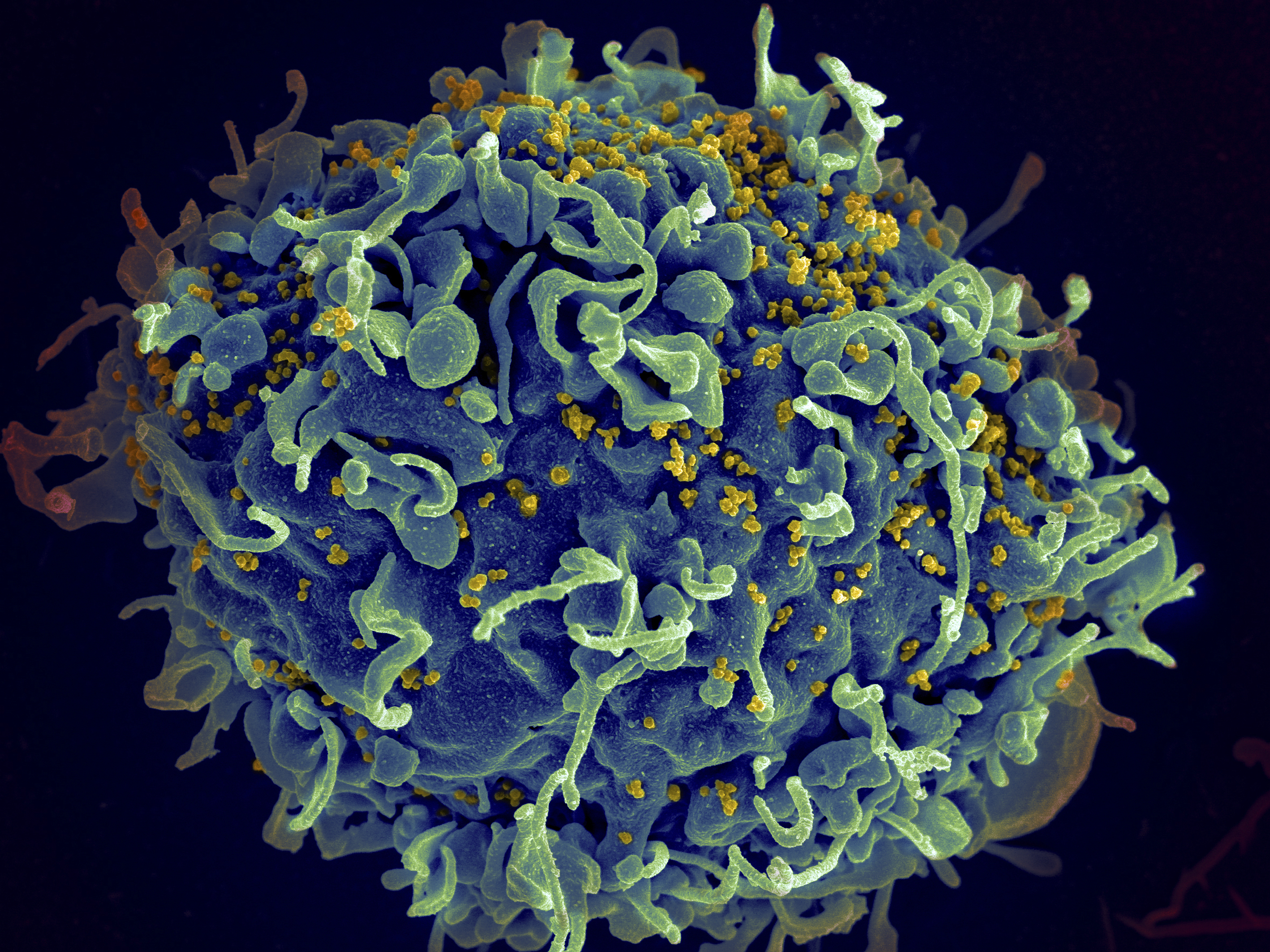 Elektronenmikroskop Aufnahme von HIV auf der Oberfläche einer menschlichen Immunzelle